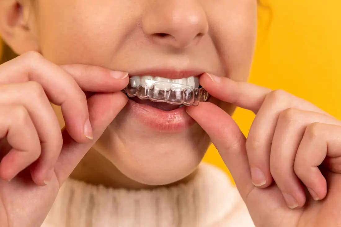 A patient fitting a clear aligner